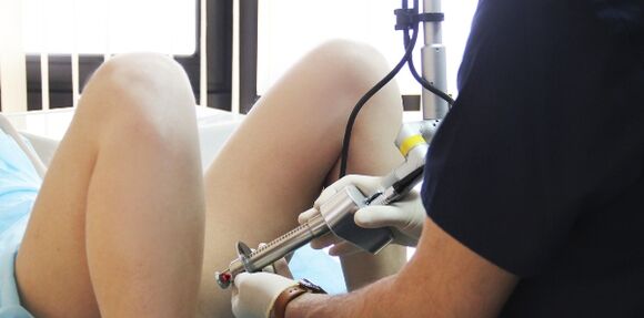 Eliminación de condilomas con láser